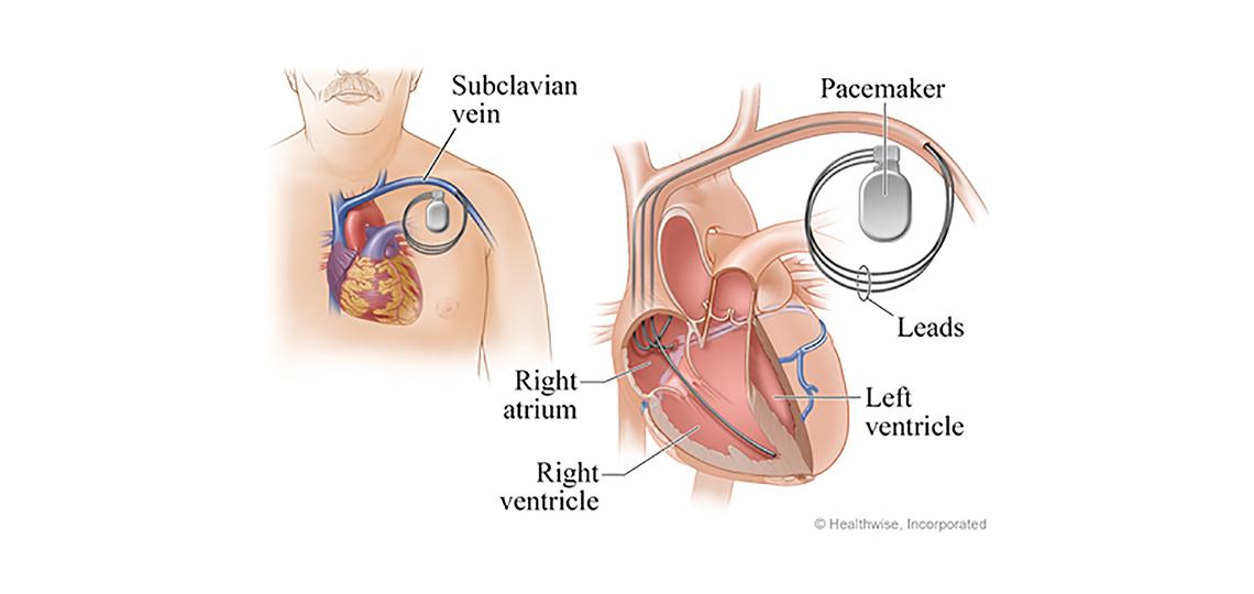 Pacemaker Placement